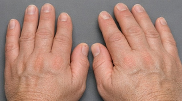 bong-dung-ban-tay-ban-chan-to-ra-co-the-la-dau-hieu-benh-ly-nguy-hiem